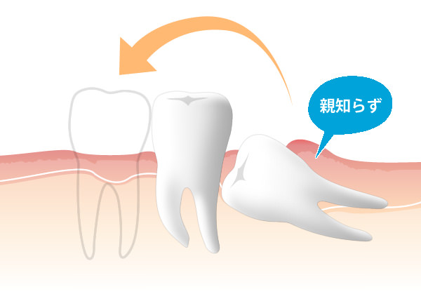 自家歯牙移植（歯の移植）にも対応